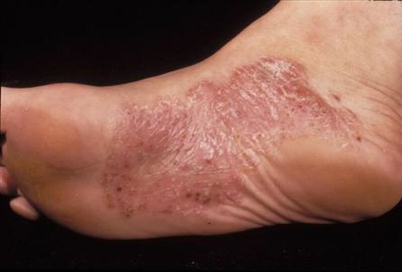 symptoms of psoriasis on the foot