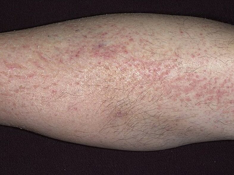 symptoms of psoriasis on the legs