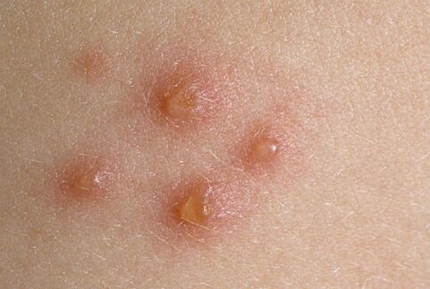 skin lumps in psoriasis