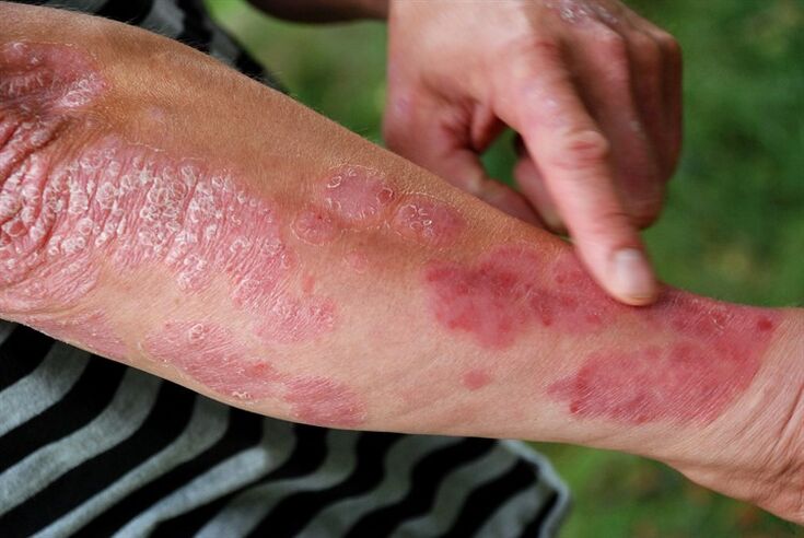psoriatic plaques on the arm