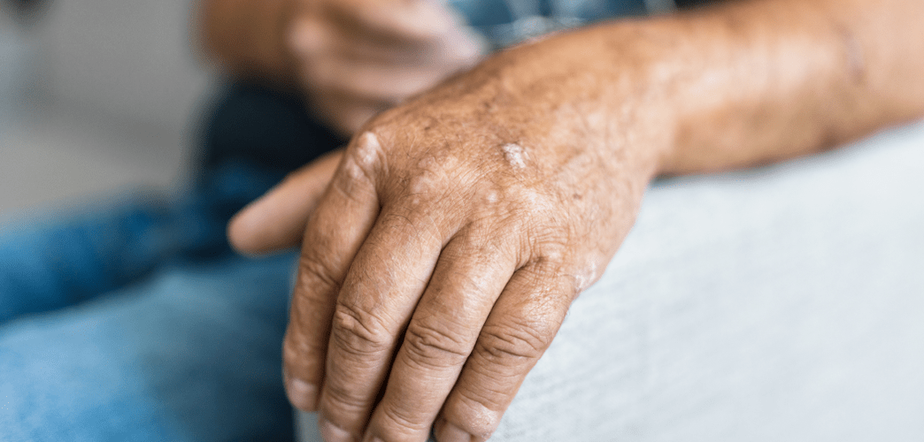 Psoriasis on the skin of the hand
