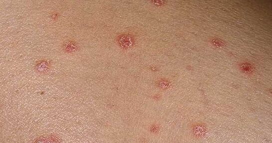 PSORIATIC PLACES