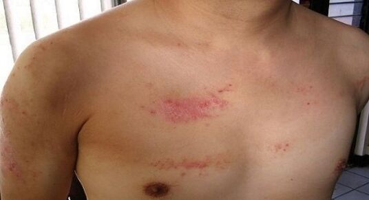Psoriasis in the chest