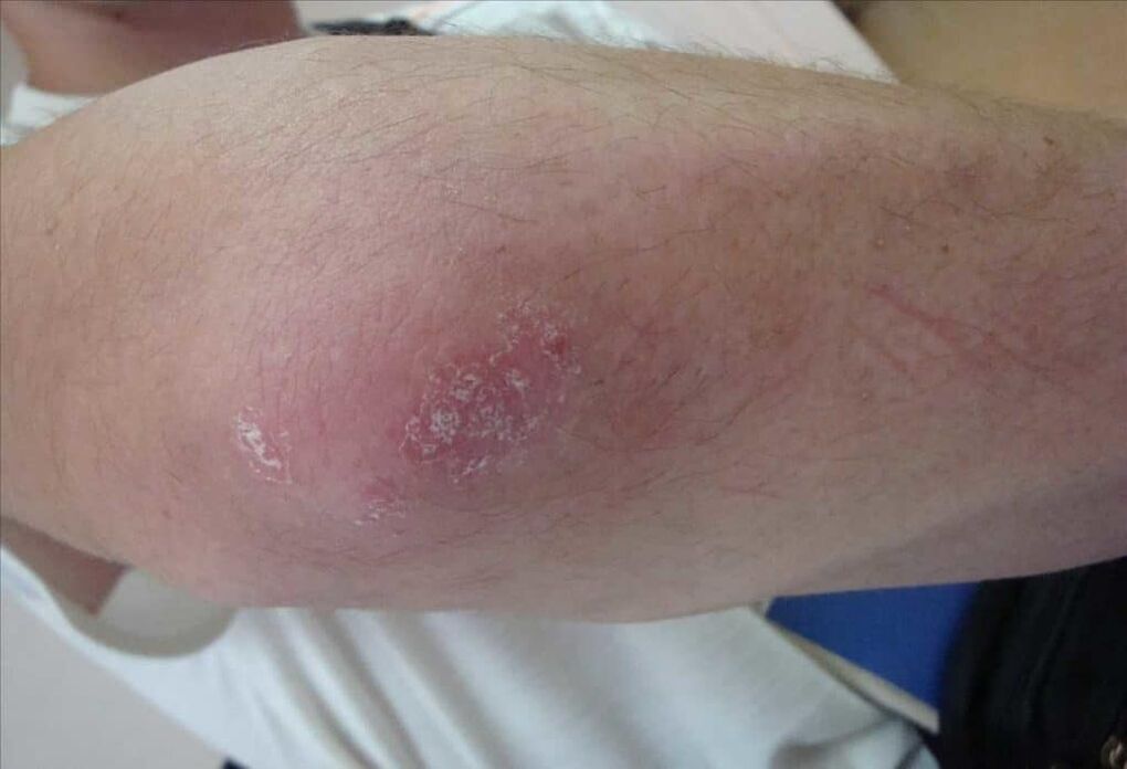 What the psoriasis looks like