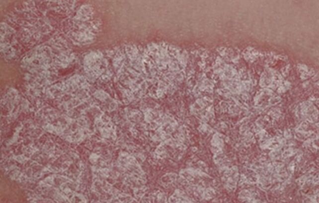 Papules healing