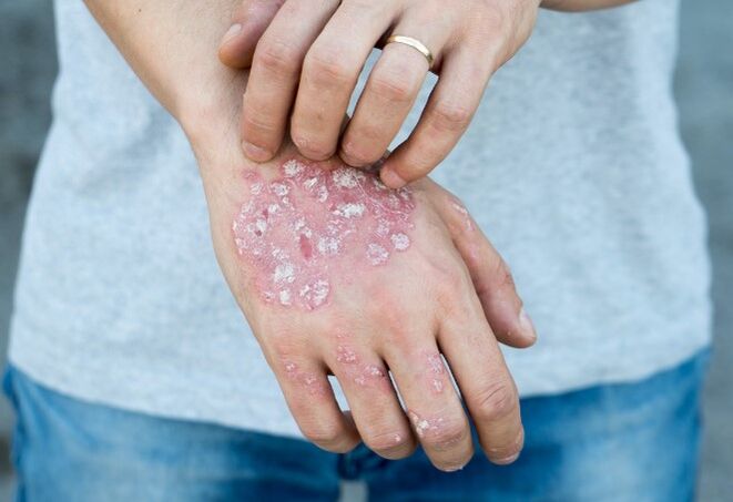 Psoriasis in Mesnicration