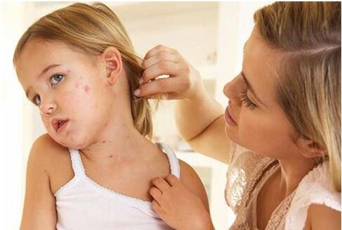 Psoriasis in children