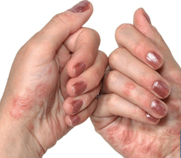 Hands psoriasis