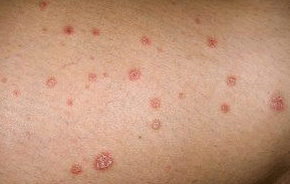 PSORIATIC PLACES