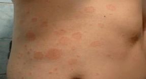 Unlucky psoriasis