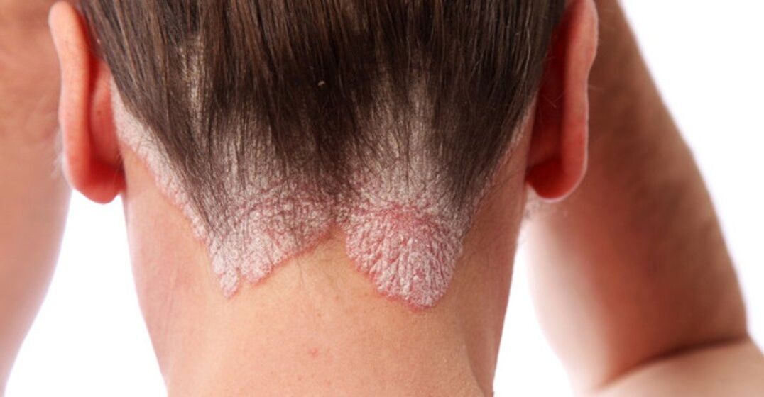 Psoriasis on the girl's heads