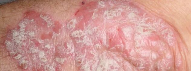 Psoriasis in Mesnicration