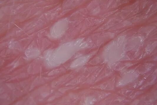 Pustulia psoriasis