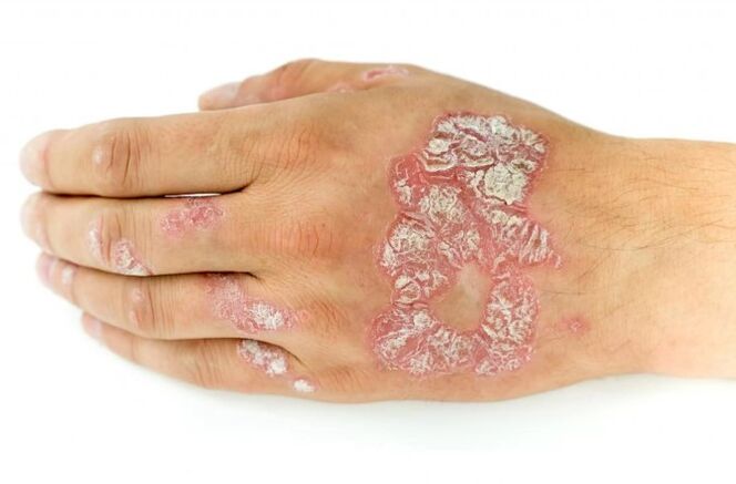 The stearine spot