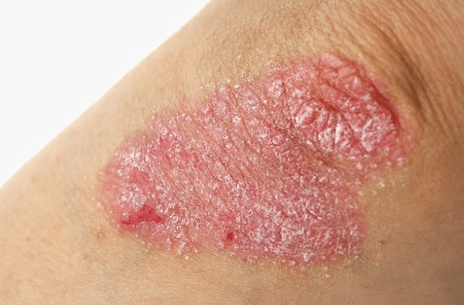 Progressive stage of psoriasis