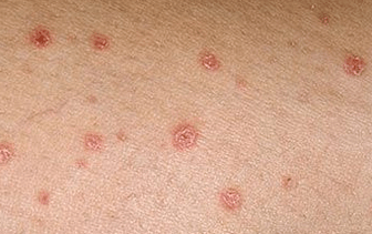 Psoriasis at the very beginning