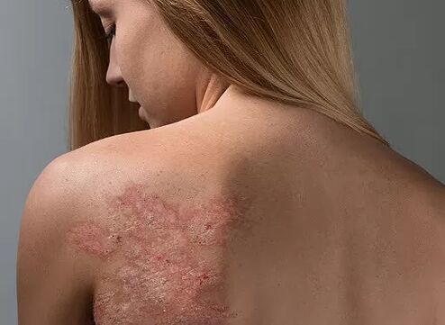 Psoriasis on a girl's back