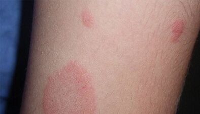 How does the initial stage of psoriasis manifest