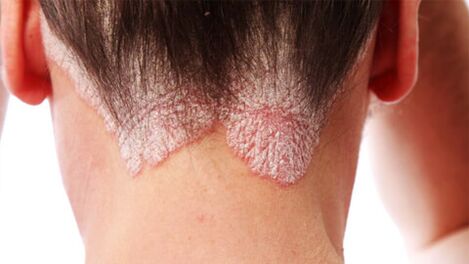 Psoriatic plaques on the scalp