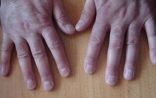 symptoms of psoriasis in the initial stage