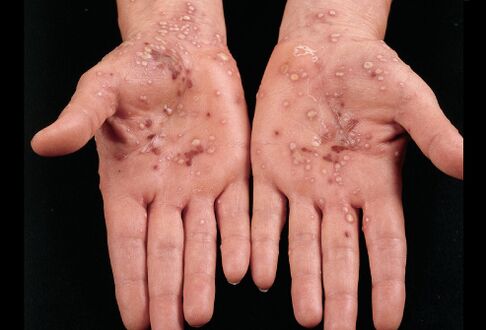 what psoriasis looks like on the palms of the hands