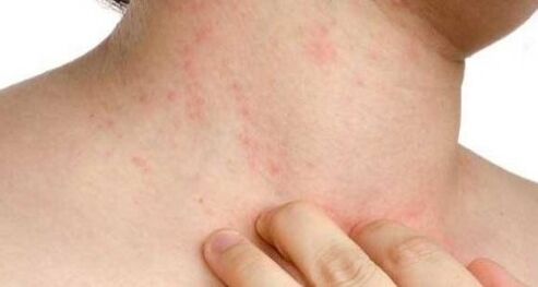 itchy skin in the initial stage of psoriasis