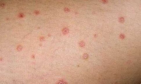 manifestations of the initial stage of psoriasis on the skin
