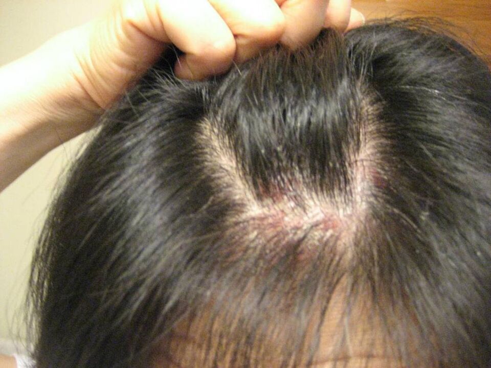 Psoriasis drops on the head