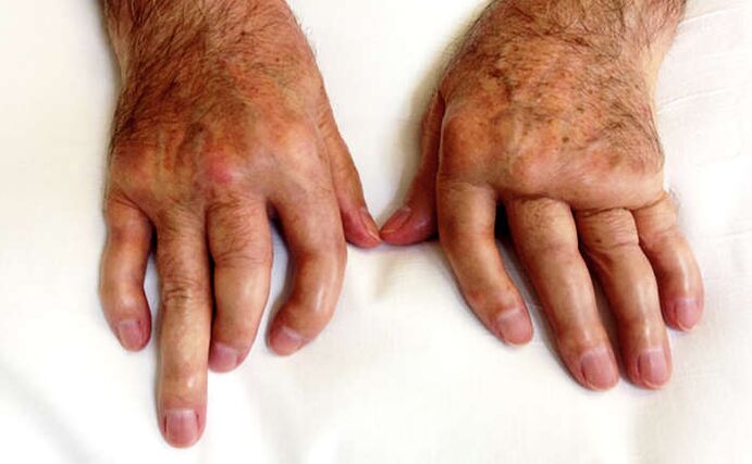 Arthritis mutilantes in psoriasis