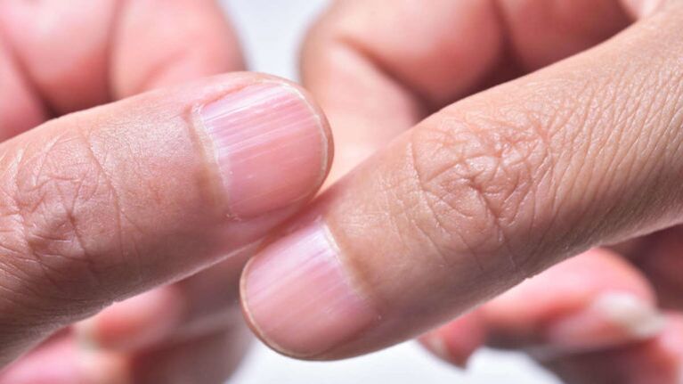 Psoriasis of the nails on the hands and feet: causes, diagnosis and  symptoms with photo | Official site Dr. DERM