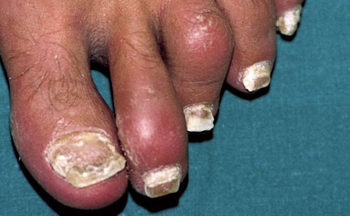 Psoriasis with nail involvement and inflammation of the joints (arthritis) of the toes