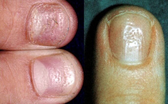 Thimble symptom - several depressions on the surface of the nail plate