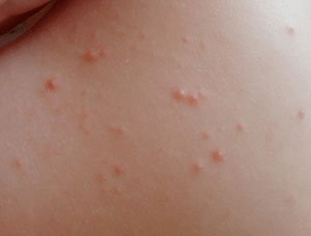 symptom of psoriasis point rash