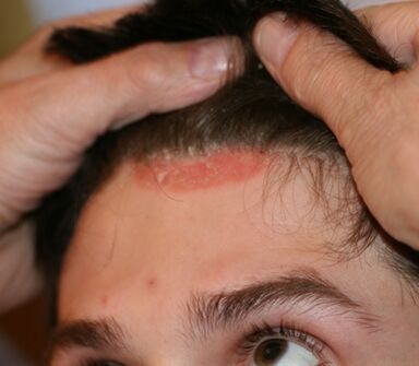 psoriasis on the head