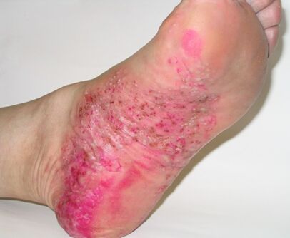 psoriasis in the foot